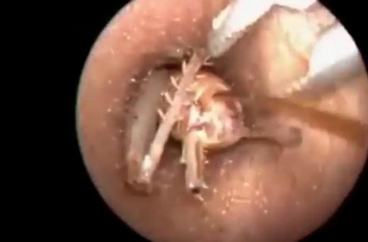 Vājprāts! Ārsts vīrieša ausī atrod baisu parazītu - VIDEO